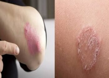 पावसाळ्यात फंगल इन्फेक्शनपासून स्वतःचं संरक्षण कसं करावं?