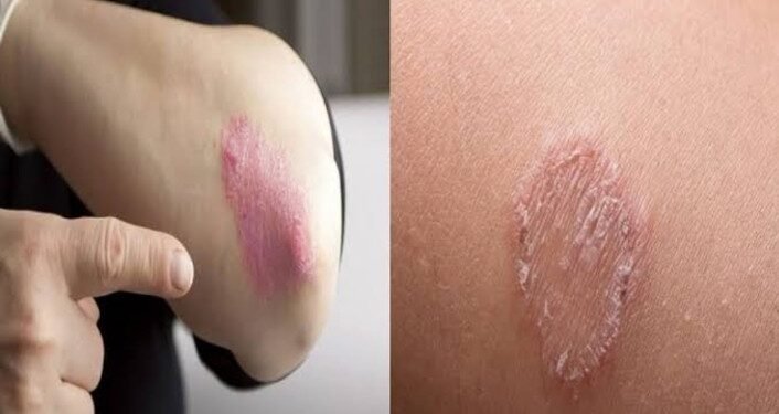 पावसाळ्यात फंगल इन्फेक्शनपासून स्वतःचं संरक्षण कसं करावं?