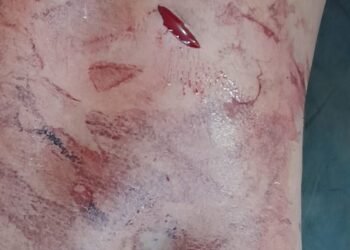 ब्रेकिंग: अमळनेर लोंढेवे जवळील हॉटेल वर वाद; पाच ते सहा जणांवर चाकू हल्ला