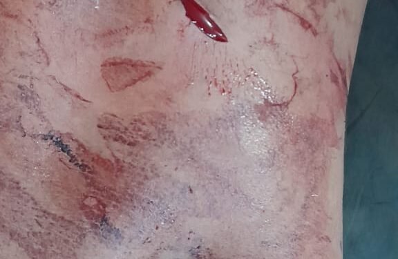 ब्रेकिंग: अमळनेर लोंढेवे जवळील हॉटेल वर वाद; पाच ते सहा जणांवर चाकू हल्ला